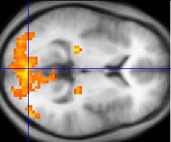 Example of fMRI scan